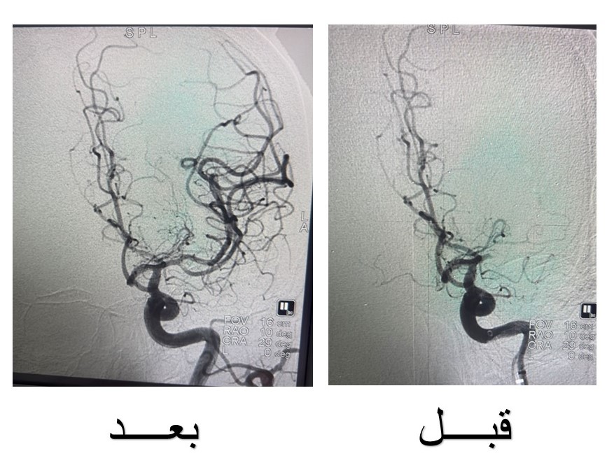 المستشفى التخصصي يعالج جلطة دماغية حادة خلال عشرين دقيقة فقط في سابقة فريدة من نوعها